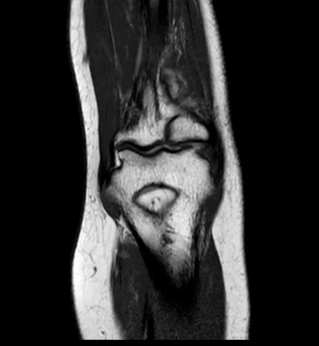 Переломы костей таза кт. Мрт кости. Мрт голеностопного сустава. Кт (мскт) височных костей. Остеогенная саркома мрт.