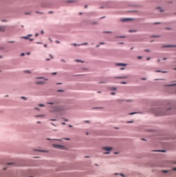 нормальный миокард. нормальный миокард. нормальный миокард. ишемическая кардиомиопатия гистология. гипертрофия миокарда препарат патанатомия.