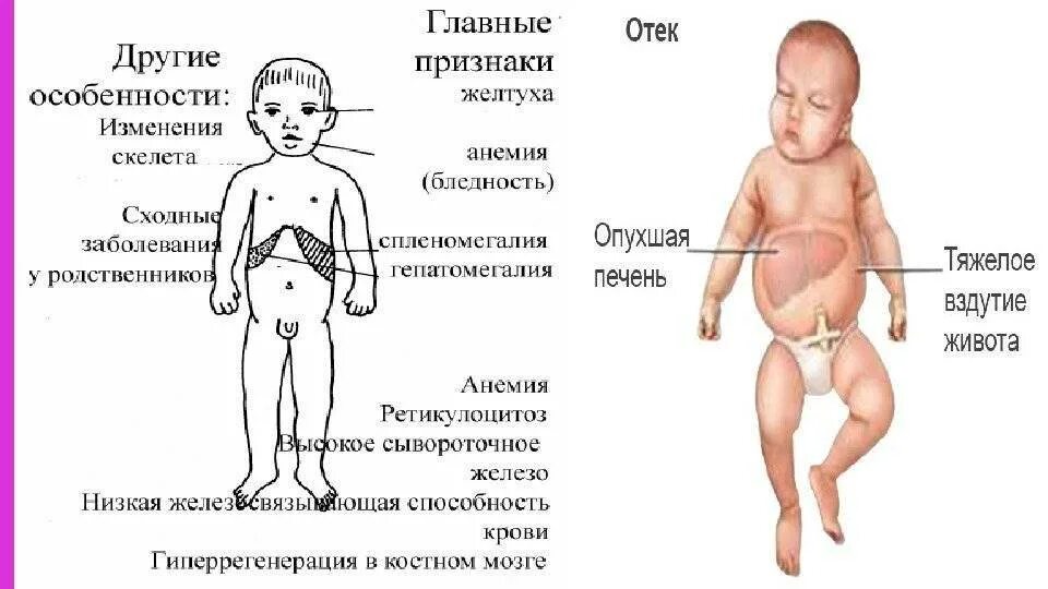 Симптомы печени у ребенка