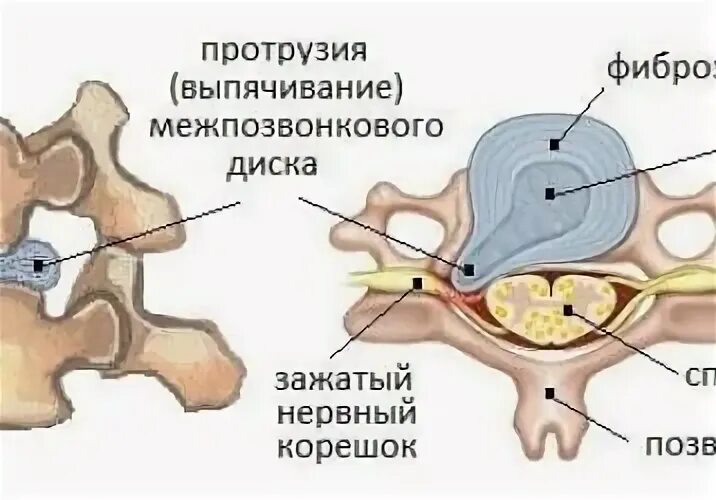Разрыв фиброзного кольца межпозвоночного диска. Разрыв фиброзного кольца межпозвоночного. Пульпозное ядро межпозвоночного диска. Надрыв фиброзного кольца. Фиброзное кольцо межпозвоночного диска.