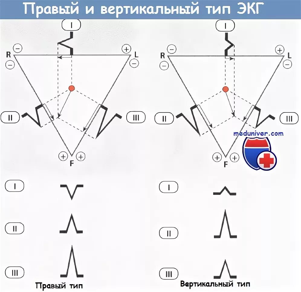 Вертикальная позиция сердца. Ось сердца на ЭКГ. Электрическая ось сердца вертикальная. Вертикальная электрическая ось сердца у ребенка. S Тип ЭКГ.