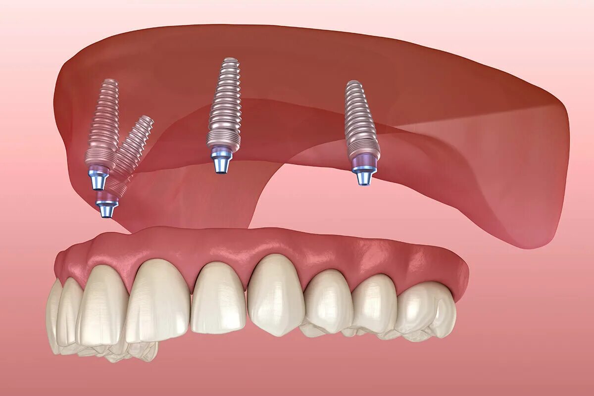 Имплантация верхней челюсти на 4 имплантах.