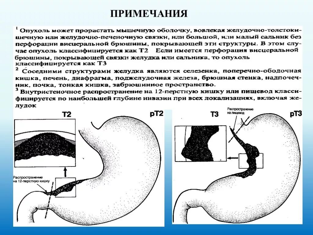 Новообразование привратника желудка. Привратник желудка опухоль. Раковый стеноз привратника желудка. Операция удаления опухоли желудка