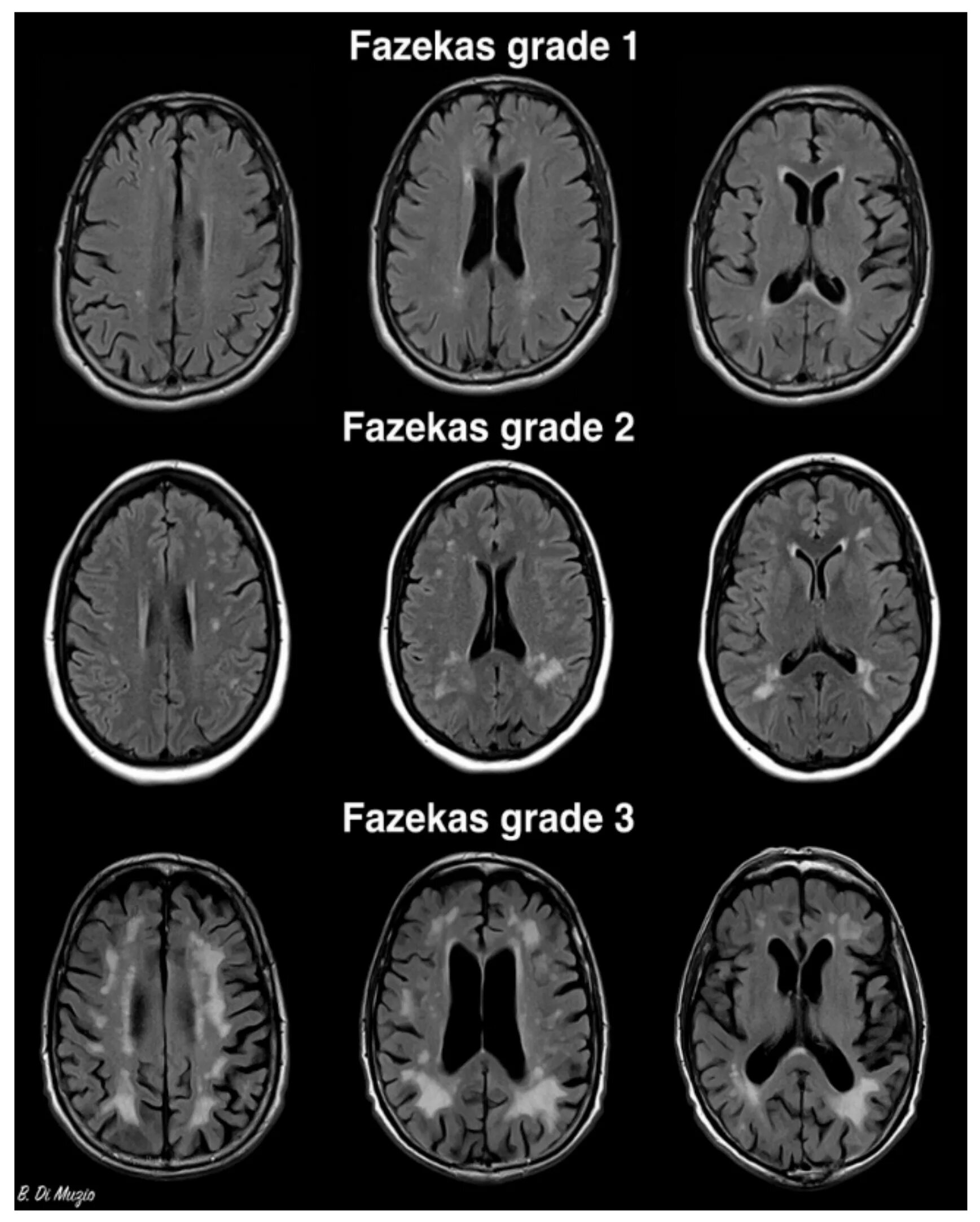 Атрофия полушарий. Лейкоареоз 2 степени по Fazekas. Очаги микроангиопатии в веществе головного мозга Fazekas Grade 1. Лейкоареоз 3 степени по Fazekas. Fazekas мрт головного мозга.