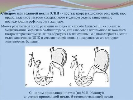 Синдром петля
