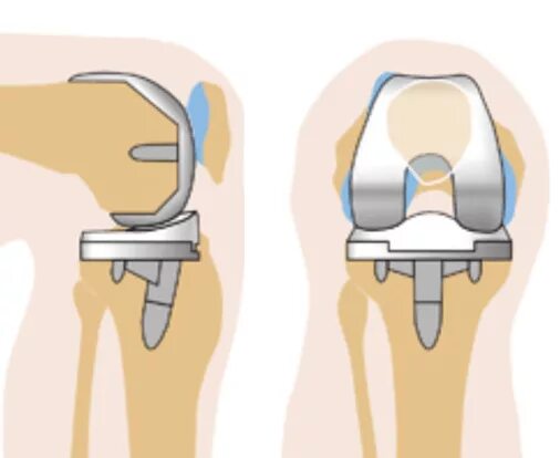 Genesis 11ps эндопротез коленного сустава. эндопротез коленного сустава. эндопротез тазобедренный stryker v40tm. Corail 9 протез. протез коленного сустава.