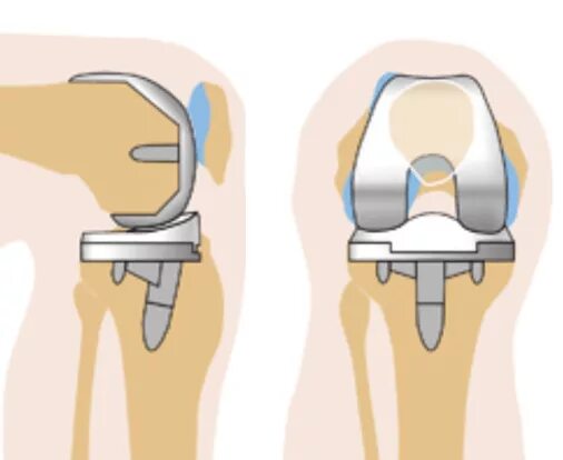 Бесплатная замена коленного сустава