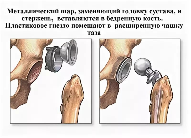 Перелом шейки бедра операция эндопротез. Операция таза тазобедренного сустава. Головки бедренной кости операция. Некроз тазобедренного сустава протез. Операция сустав шейки бедра