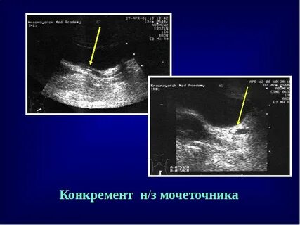 Исследование конкремента