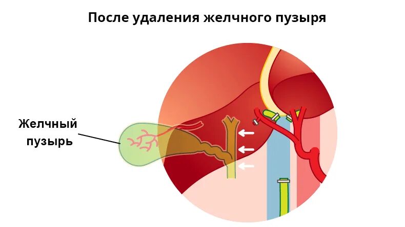 После удаления желчного поднимать тяжести. Постхолецистэктомический синдром. Синдром после холецистэктомии. После удаления желчного пузыря. Синдром удаленного желчного пузыря.