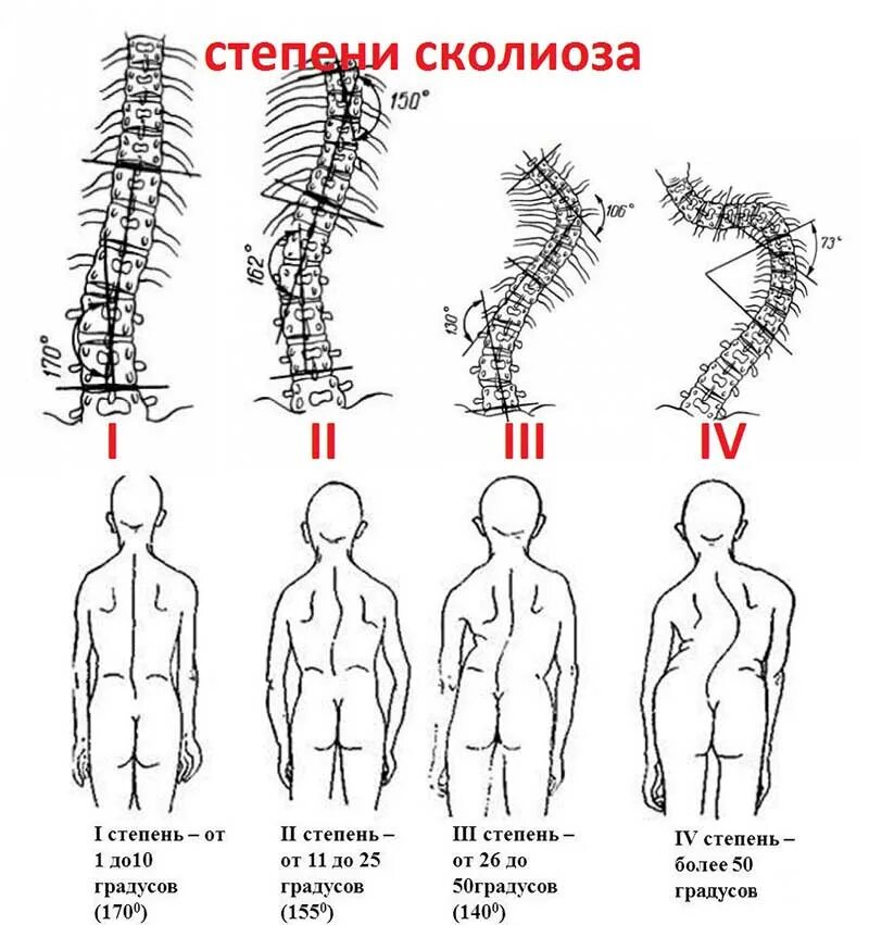 Изменение формы позвоночника. С образное искривление позвоночника 1 степени. Позвоночник при сколиозе 2 степени. S образный сколиоз 2 степени. S образный сколиоз 1 степени по чаклину.