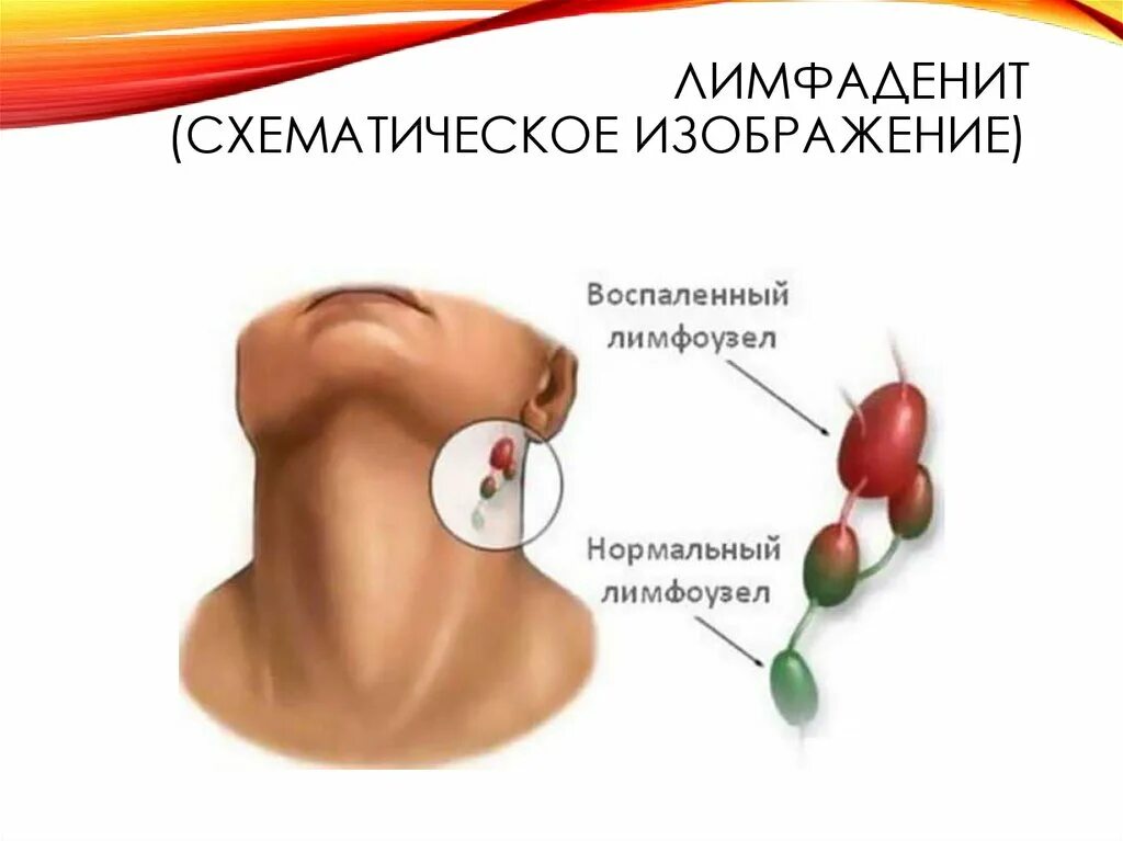 Что воспаляется под челюстью. Что воспаляется под челюстью