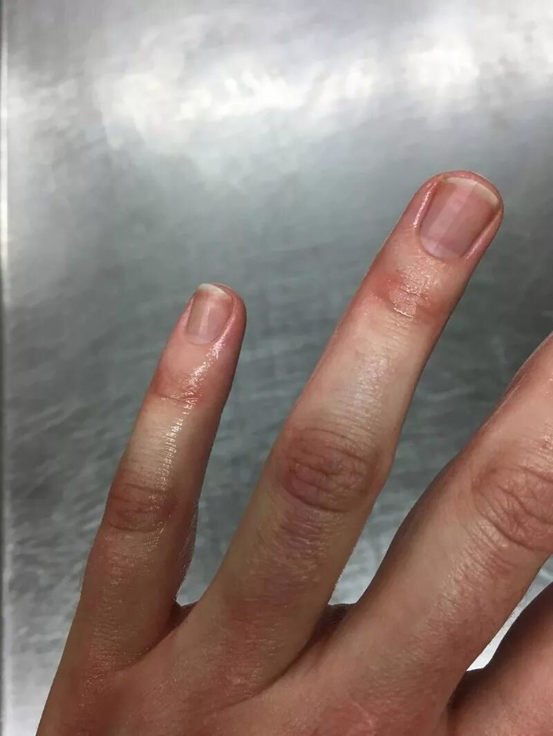 Почему руки постоянно потеют. Аллергический дерматит на пальцах. Кожные заболевания на пальцах рук.