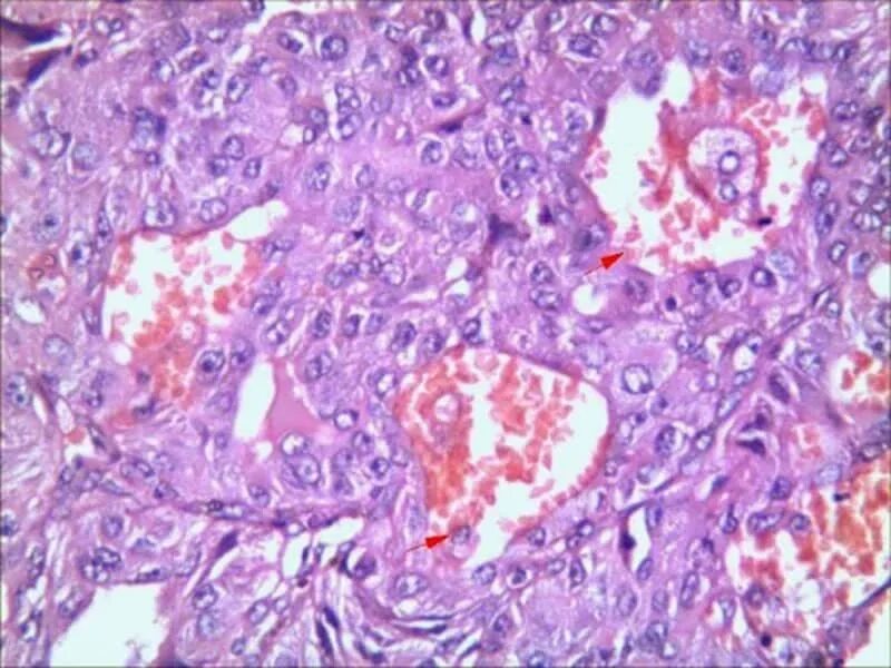 Немелкоклеточная карцинома. Плоскоклеточный Канцер g-1. Прогрессирующая опухоль. Плоскоклеточный Канцер g2. Стадии рака легких плоскоклеточный