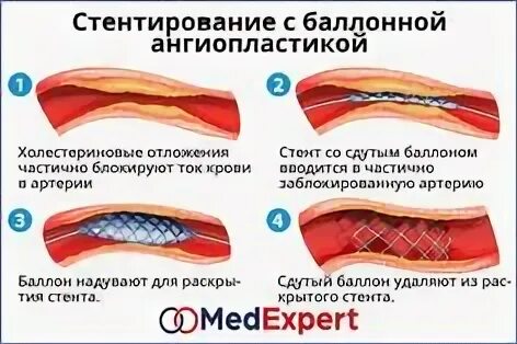 Стентирование отзывы