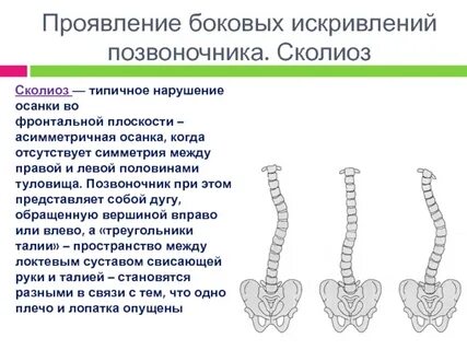 Боковое искривление