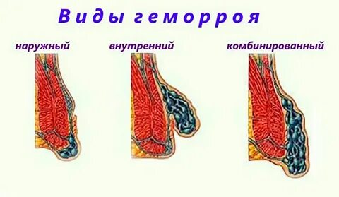 Наружный внутренний и комбинированный