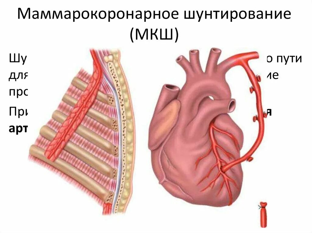 Операции коронарных артерий. Маммарокоронарное шунтирование (МКШ). Операция МКШ В кардиологии. Коронарное шунтирование сосудов.