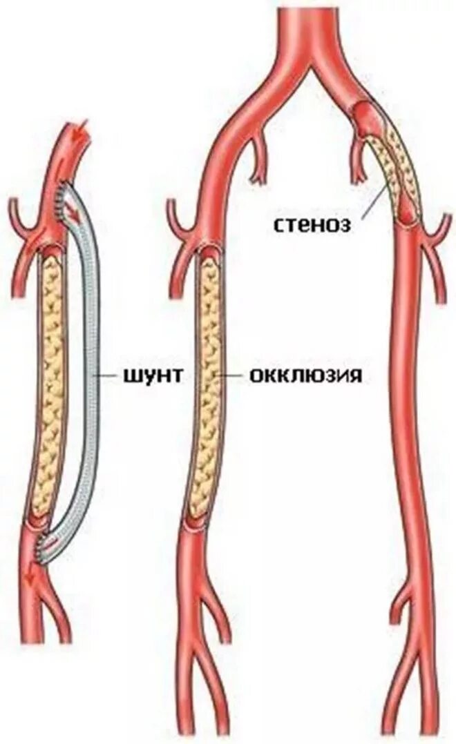 Операция коронарных сосудов. Шунт артерии нижних конечностей. Аорто бедренное шунтирование. Коронарное шунтирование сосудов сердца. Шунтирование артериального сосуда.