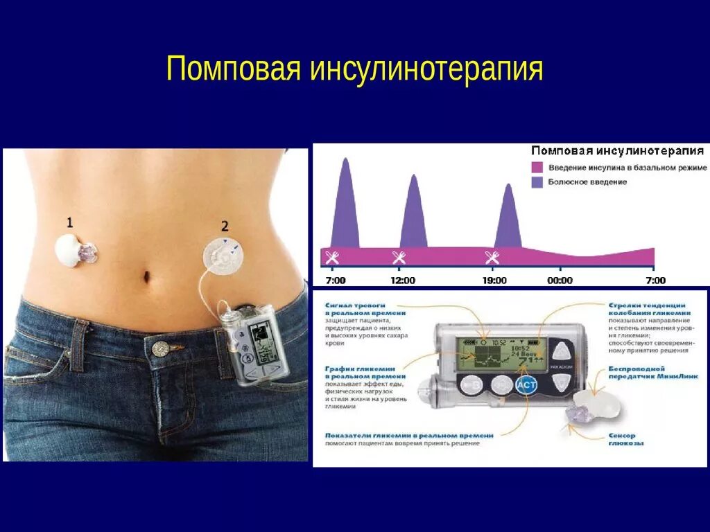 Устройство для введения инсулина. Сахарный диабет инсулинотерапия. Введение инсулина при сахарном диабете 1 типа. Помповая инсулинотерапия. Схема введения инсулина.