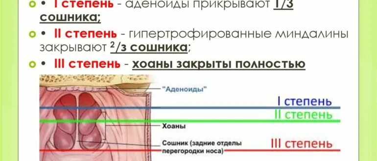 Аденоидный вегетация 3. Гипертрофия аденоиды 2 степени. Гипертрофия миндалин с гипертрофией аденоидов 3 степени. Аденоиды 2-3 стадии у детей.