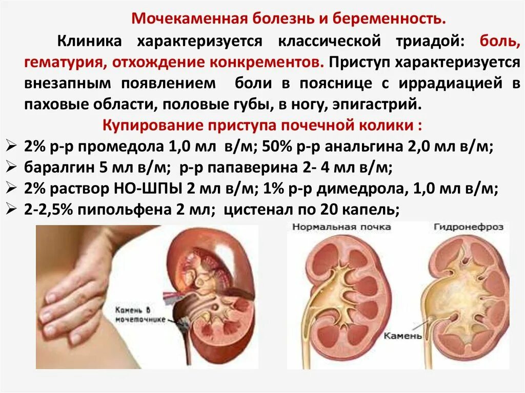 Пиелонефрит 3 триместр. Мочекаменная болезнь и беременность. Почки при беременности. Болезни почек мочекаменная болезнь. Мочекаменная болезнь почечная колика.