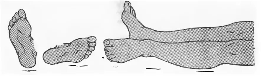 перелом шейки бедра реабилитация. положение конечности при переломе шейки бедра. стопа при переломе шейки бедра. перелом шейки бедра ротация стопы. гимнастика при переломе шейки бедренной кости упражнения.