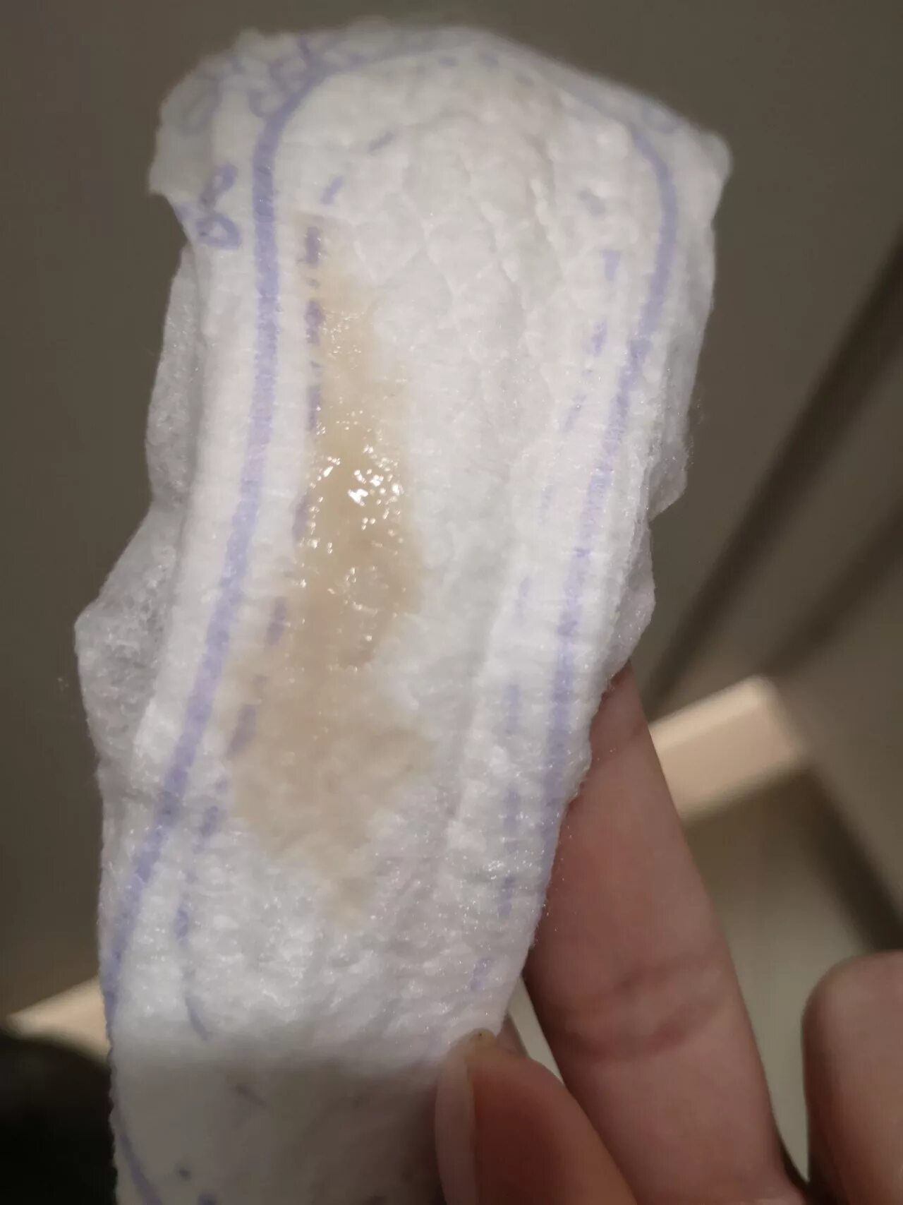 Может ли молочница быть признаком