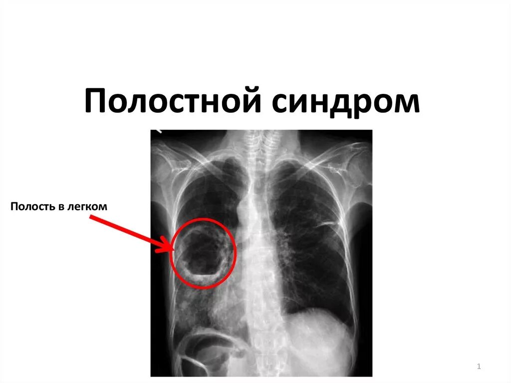 Синдром полости в легочной ткани. Образование полости в легком. Синдром полости в легком. Синдори полости в легких. Полостные образования в легких