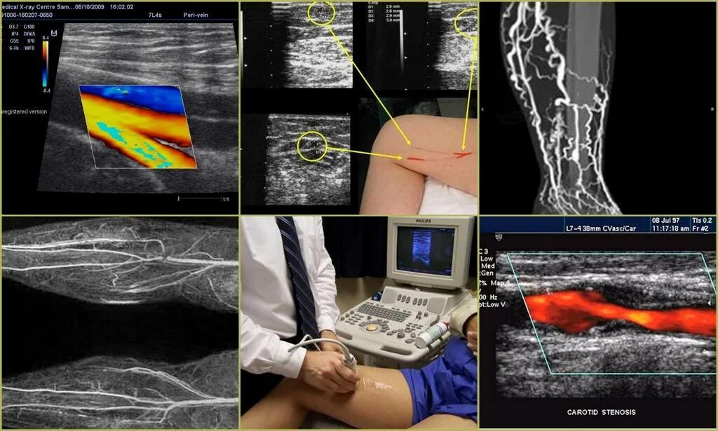 Дуплексное сканирование вен нижних конечностей что это. Ультразвуковая допплерография артерий нижних конечностей. Ультразвуковое компрессионное дуплексное ангиосканирование. Тромбоз нижних конечностей УЗИ. Тромбофлебит ультразвуковое дуплексное ангиосканирование..