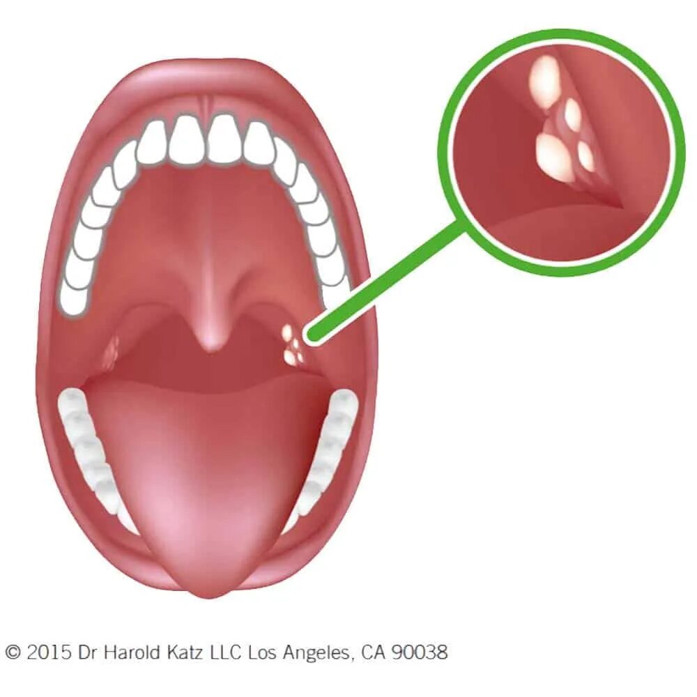 Гнойники на миндалинах у ребенка. Резиновые глотки
