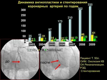 После стентирования давление высокое