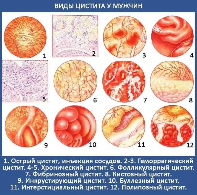 Рецидив цистита. Геморрагический цистит. Острый геморрагический цистит.