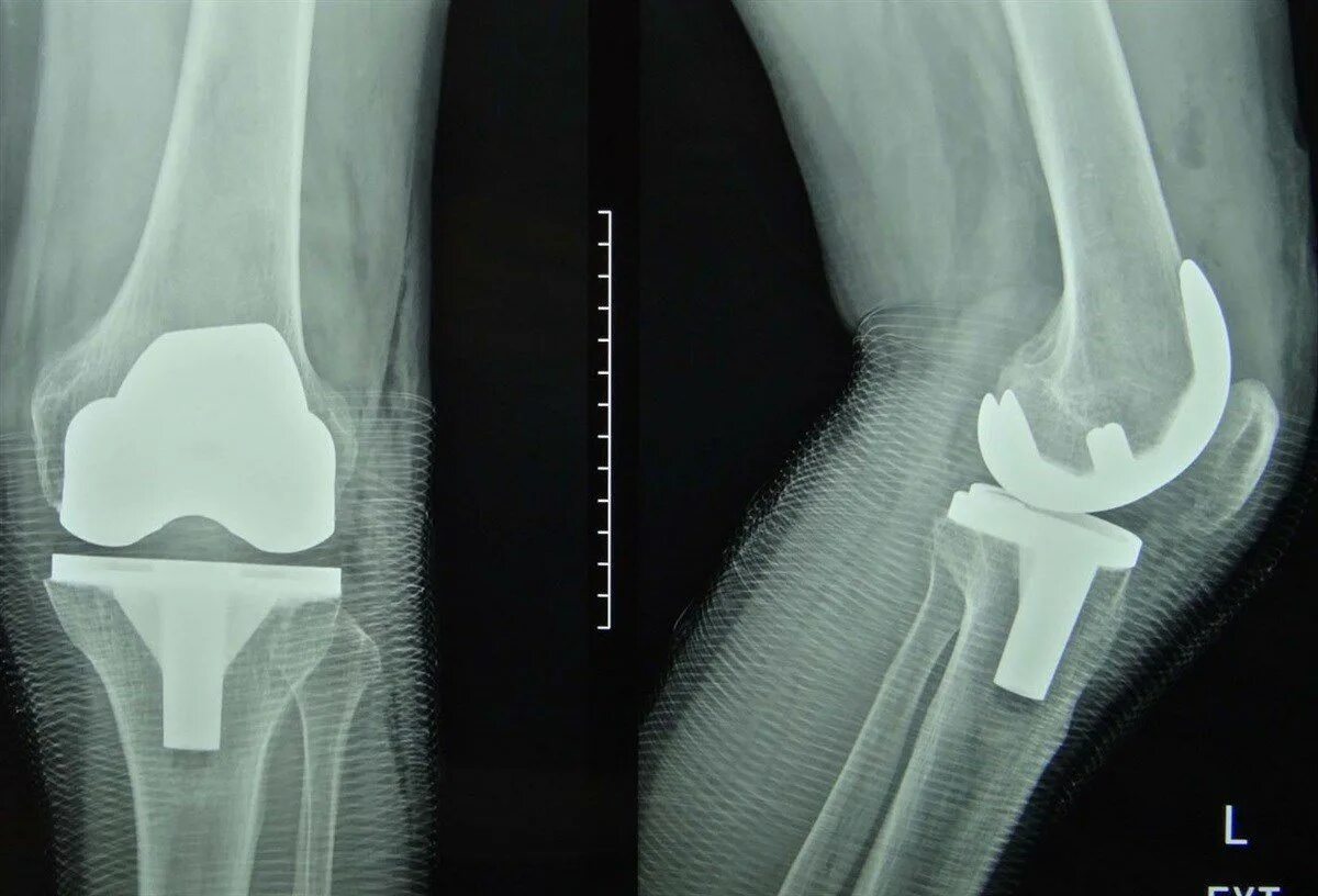 Эндопротез коленного сустава рентген. Тотальное эндопротезирование коленного сустава рентген. Остеопороз коленного сустава рентген. Тотальный эндопротез коленного сустава рентген.
