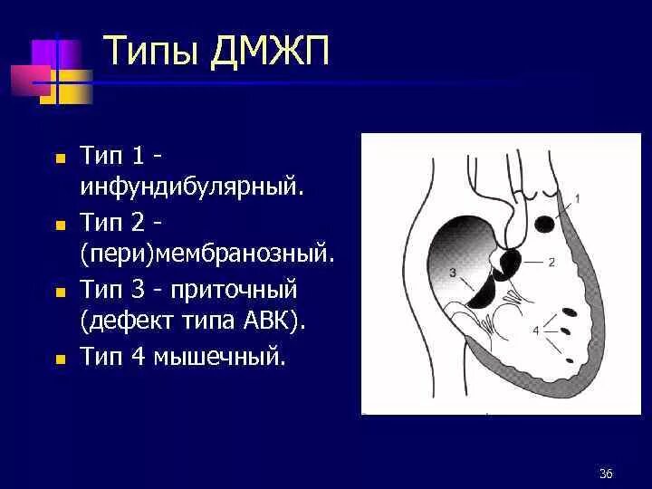 Код мкб дмжп у детей
