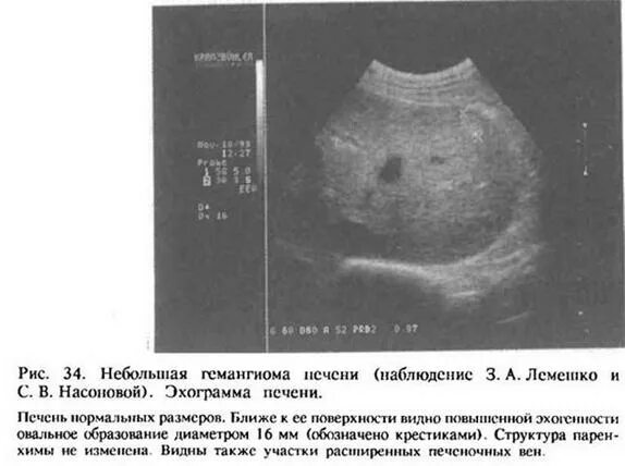 Гемангиома печени причины и лечение