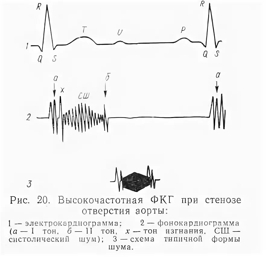 Графическое изображение фкг. Фонокардиография при аортальном стенозе. фонокардиография стеноза устья аорты. фкг стеноз устья аорты. фонокардиография при стенозе устья аорты.