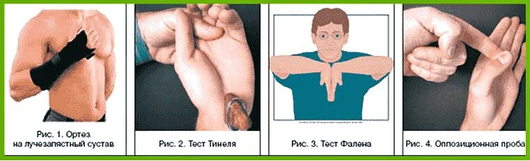 Тест большого пальца. Туннельный синдром запястья кисти. Синдром карпального канала тест Тинеля. Синдром карпального канала операция. Кистевой туннельный синдром.