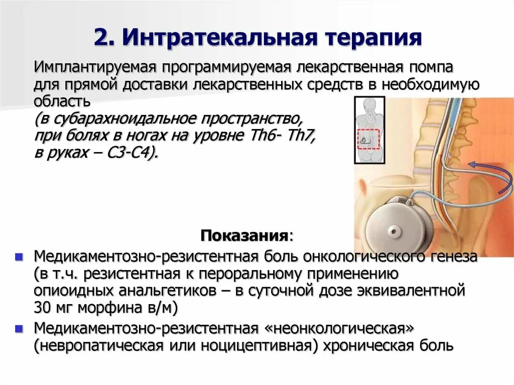 Баклофеновых помп. Интратекальное Введение препаратов. Лекарства для интратекальное Введение. Интратекальная терапия. Интратекальное Введение лекарственного препарата.