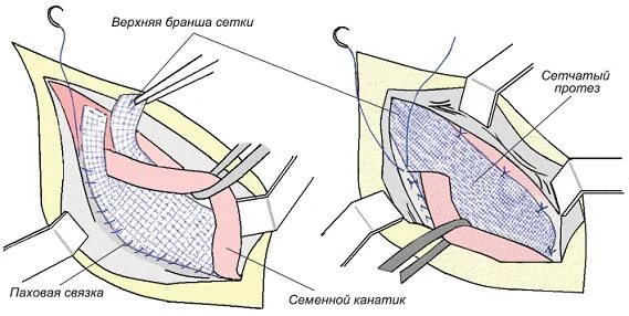 Какую сетку ставят при грыже. Операция лихтенштейна при паховой грыже схема. герниопластика по лихтенштейну. герниопластика по лихтенштейну при паховой грыже. грыжесечение по лихтенштейну при паховой грыже.
