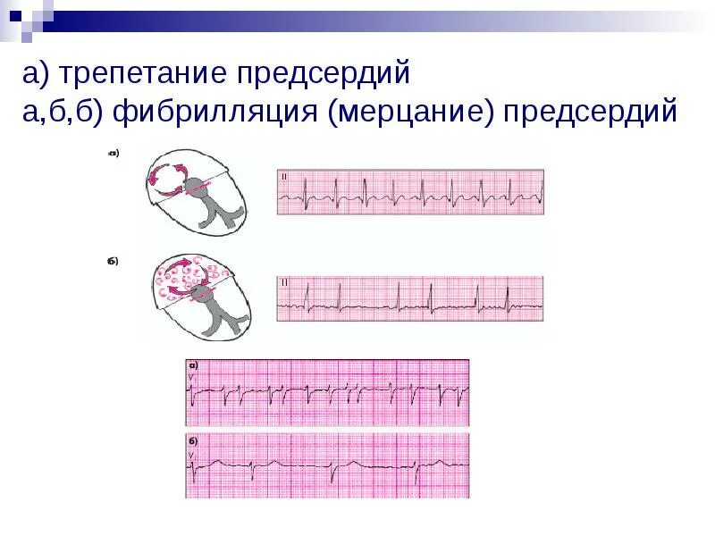 Фибрилляция предсердий 3 к 1. Формы трепетания предсердий классификация. Клинические признаки фибрилляции предсердий. Фибрилляция предсердий классификация. Формы трепетания предсердий