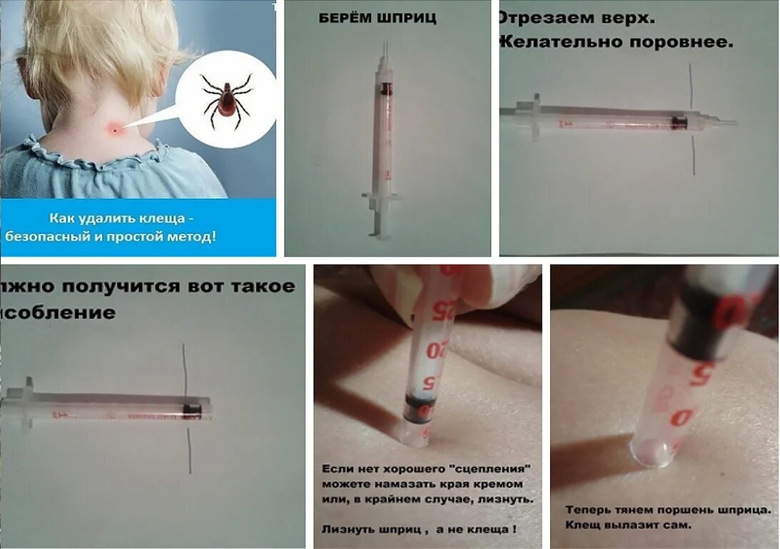 Как быстро вытащить клеща у человека. Как вытащить клеща шприцом. извлечение клеща с помощью шприца. удалить клеща с помощью шприца.