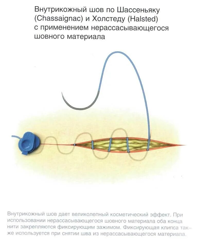 Стерильный шов. Стерилизация косметический шов. Шов хирургический внутрикожный. Косметический шов с рассасывающимися нитками. Косметический шов леской.