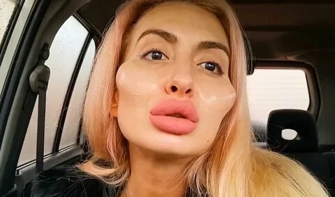 Женщина сделавшая скулы