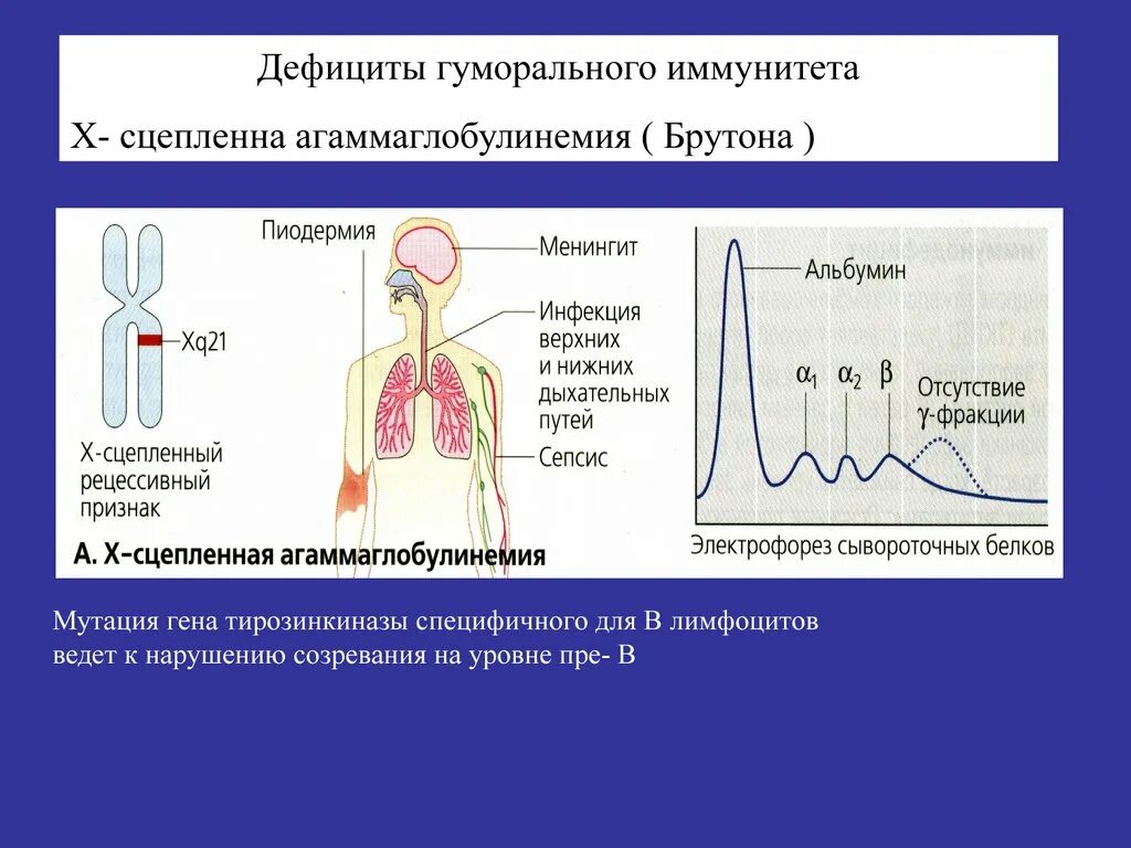 Иммунодефицит брутона. Агаммаглобулинемия Брутона. Х-сцепленная агаммаглобулинемия. Агаммаглобулинемия Брутона у детей.