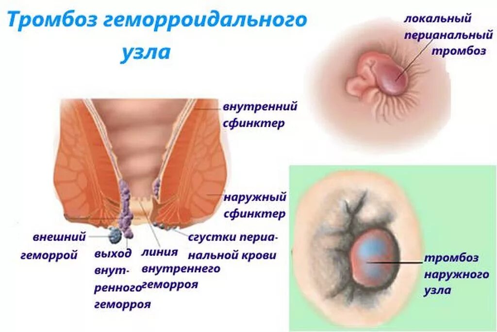 Геморрой узел стадии наружные. Геморройный узел наружный 3 стадия. Как выглядит геморрой при беременности. Воспаление геморроидальных узлов. Боли внутри заднего прохода