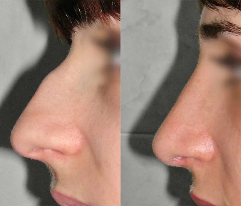 Исправление горбинки носа. Ринопластика до после горбинка. Пластика носа. Удалить горбинку на носу. Нос до и после ринопластики с горбинкой.