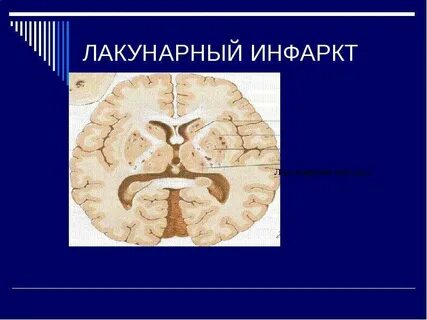 Лакунарный инфаркт