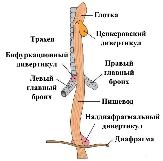 Бифуркационный дивертикул пищевода. Дивертикул пищевода схема. Дивертикулы пищевода этиология. Строение дивертикула пищевода.