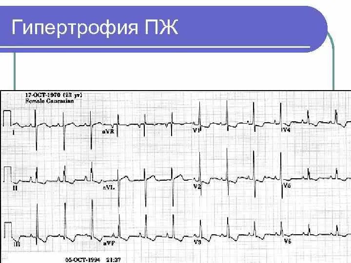 Гипертрофия правых отделов сердца на ЭКГ. Гипертрофия левого и правого желудочка на ЭКГ. S Тип гипертрофии правого желудочка на ЭКГ. Гипертрофия правого желудочка на ЭКГ. Перегрузка на экг что это